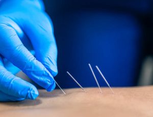 Close up of a needle and hands of physiotherapist doing a dry needling in a physiotherapy center.